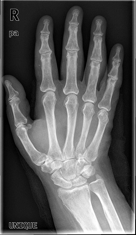 Мобильный рентген MobileDiagnost wDR